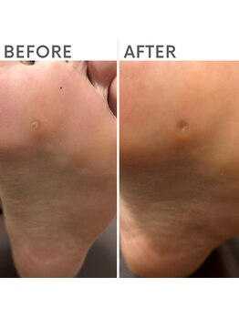 クオッカ(Quokka)/魚の目ケア