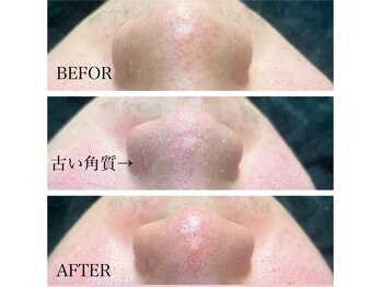 メンズプシュケ(men's PSYCHE)/毛穴洗浄