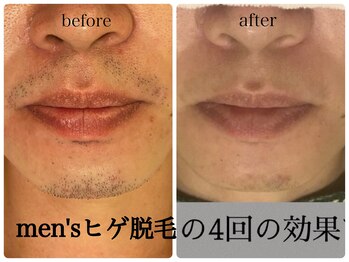 エステティックサロン アールグレー 名古屋駅店/大人気★メンズ【ヒゲ脱毛】