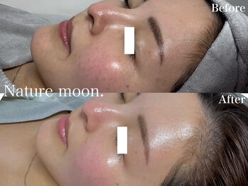 ナチュールムーン(Nature moon.)/ハーブピーリング