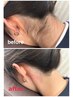 うなじ脱毛¥5500→￥3850（襟足シェービング込）