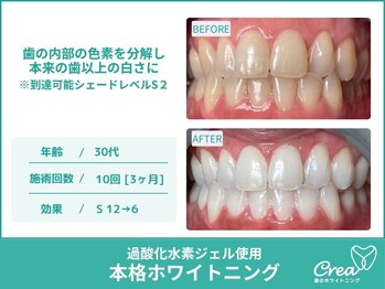 クレア(Crea)/【ホワイトニング症例写真】