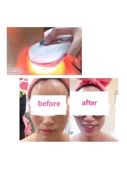 エステサロンメイ 美(MEI)/光ホット小顔フェイシャル