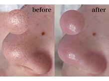 毛穴専科/韓国肌管理◇ 学割u24あり