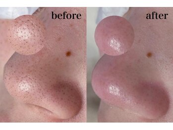 毛穴専科/韓国肌管理◇ 学割u24あり