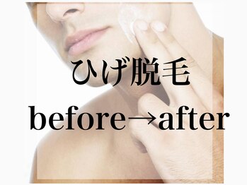 ジョアアンジェ 京橋店(joie ange)/ひげ脱毛