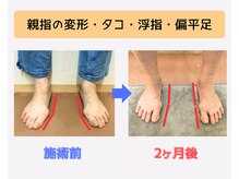戸田はりきゅう整骨院/足指整体Before・After