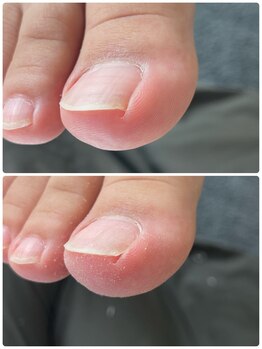 巻き爪じゅん 船橋店/専門施術でストレスの無い日常へ