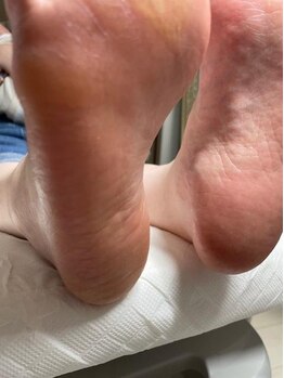 フットケアを受けたい