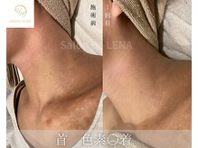 サロン ド レナ(Salon de LENA)/ハーブピーリング サロンドレナ