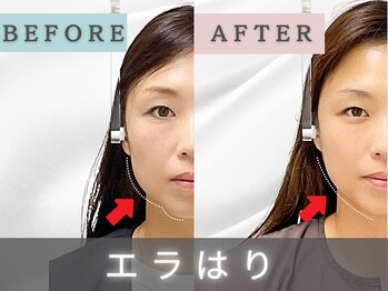 エルシンメトリー矯正院(ailesシンメトリー矯正院)/before＆after　ailes式小顔矯正