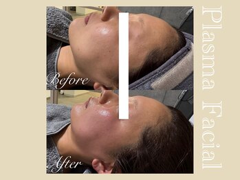 ミリュール(Millule)/アマンス&プラズマフェイシャル