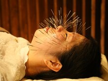 のぐち鍼灸整骨院の雰囲気（ルート美容鍼で、美容鍼より更にによくなります。）