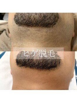 レア ビューティーサロン(Lea beauty salon)/最新光マシン脱毛