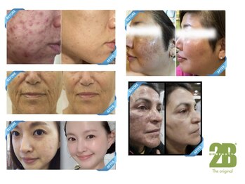 メディカルサンテロッソ 福岡店(MEDICAL SANTEROSSO)/2Bバイオトリートメント1.5g