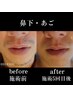 人気No.1 髭脱毛（顔全体～首まで）¥5000　メンズ脱毛/ひげ/顔脱毛/VIO脱毛