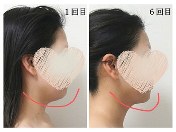 ミレア(Milea)/フェイスラインもたつき改善