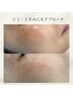 【しみ/くすみ/目元のもやもや】美白ケアはコレでOK！20,000円～