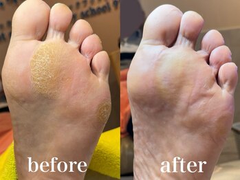 ドクターネイル爪革命 札幌本店/症例紹介20 たこ