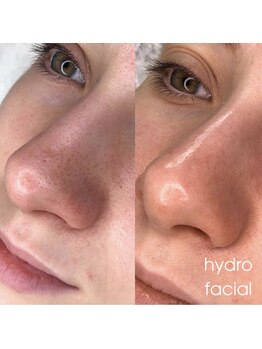 アンノウン 神戸元町店(Unknown.)/毛穴洗浄