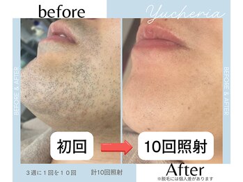 ユシェリア(Yucheria)/ヒゲ脱毛経過