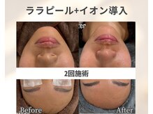 イーラボ 池袋店(e-LABO)/韓国肌管理/ララピール