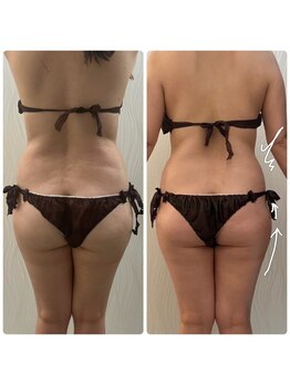 ソルニス(Solnis.)/痩身☆脂肪分解/ハイパーナイフ