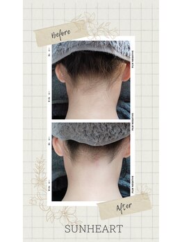 サンハート(SUN HEART)/後ろ姿美人に♪うなじ脱毛