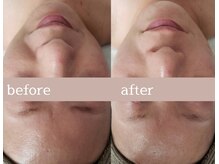 プシュケ(Psyche)/お客様の肌変化