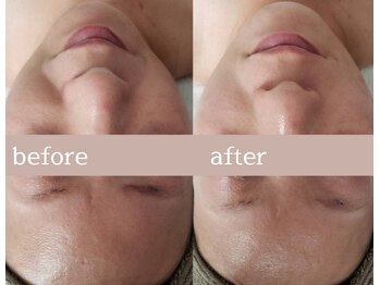 プシュケ(Psyche)/お客様の肌変化