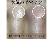 ピエル 北千住店(PIEL)/本気の毛穴ケア