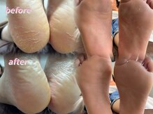 ウィズサロン(withサロン)/韓国式！足裏角質ケア