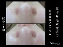 レガロビューティクリエイションズ桜川店/脱・黒ずみ！毛穴改善プログラム