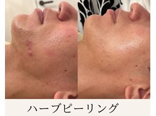 ミウ(MIU)/【 ハーブピーリング 】