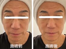 ヴィセラ(Vicella)/一回施術で引き上げ、引き締め