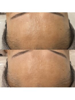 ヴェルシック(Belchic)/少しずつ確実にシワも改善できる