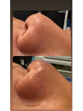 PLATINUM BROW 長岡店【12月12日 NEW OPEN（予定）】 /いちご鼻撃退！鼻before→after