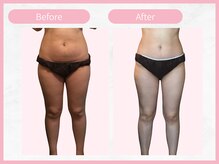 RHB 横浜店/【痩身コース】ビフォーアフター