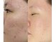 カナエル ビューティーサロン(Canael Beauty salon)の写真/結果重視！大人気のプロセルで毛穴、シミしわ、たるみなどのあらゆるお肌悩みをスピード改善