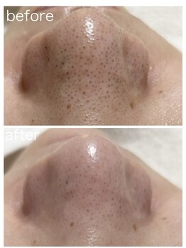 毛穴塾/即日効果実感◎毛穴撲滅(鼻のみ)