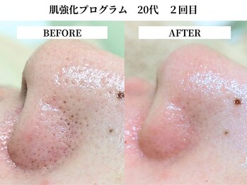 サンビ(SANBI)/気温上昇で皮脂も出やすい時期に