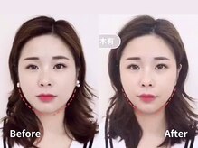 独自の小顔矯正技術で骨から美しい顔へデザインしていきます。