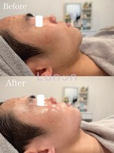 ルノン(Lunon)/毛穴洗浄ハイドロ