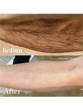 モット 神戸店(Motto)/メンズ脱毛