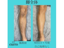 アクト クロ(ACT curro)/【脚全体】脱毛施術例