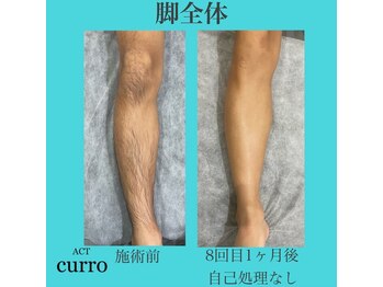 アクト クロ(ACT curro)/【脚全体】脱毛施術例