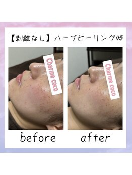 シャルム ココ 八尾店(Charme coco)/剥離なし ニキビケア 1回目