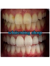 ホワイトニングショップ 出雲店/ビフォーアフター