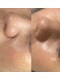 キャンディサロンの写真/【速攻実感◎】くすみがとれてワントーンUP♪韓国の皮膚科が監修した製品を使用した最新ピーリング！