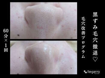 レガロビューティクリエイションズ桜川店/脱・黒ずみ！毛穴改善プログラム